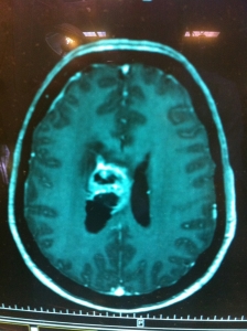 Neuro-Oncología
